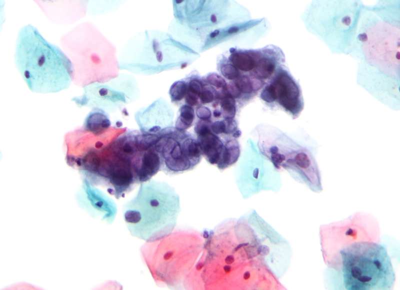 Micrograph showing the changes of herpes simplex virus (HSV). (Source: Wikimedia/Nephron)