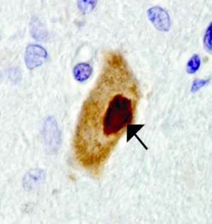 Dense protein aggregations in the motor neurons of ALS patients suggest a possible mechanism of disease. (Source: University of Pennsylvania)